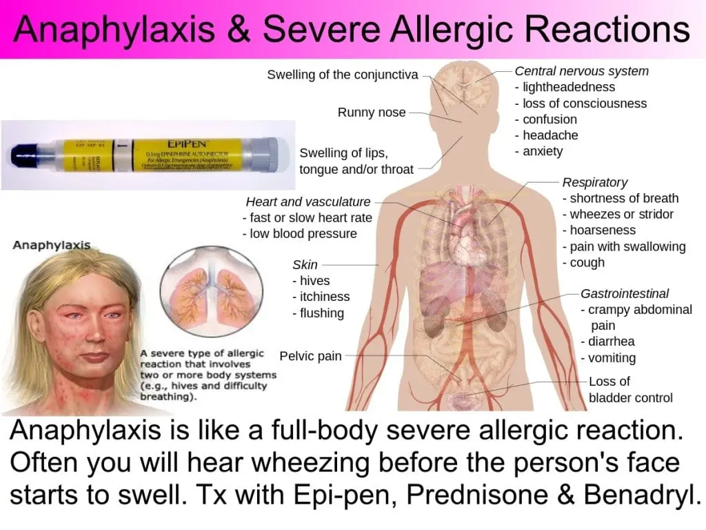 Anaphylactic Shock In Pulse CPR