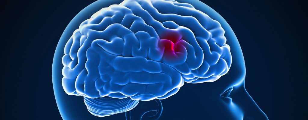 Why it is important to notice the signs of a stroke early